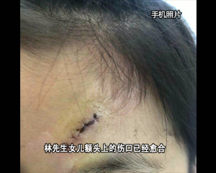 被送到医院后,女儿左边额头的伤口部位被缝合了9针.