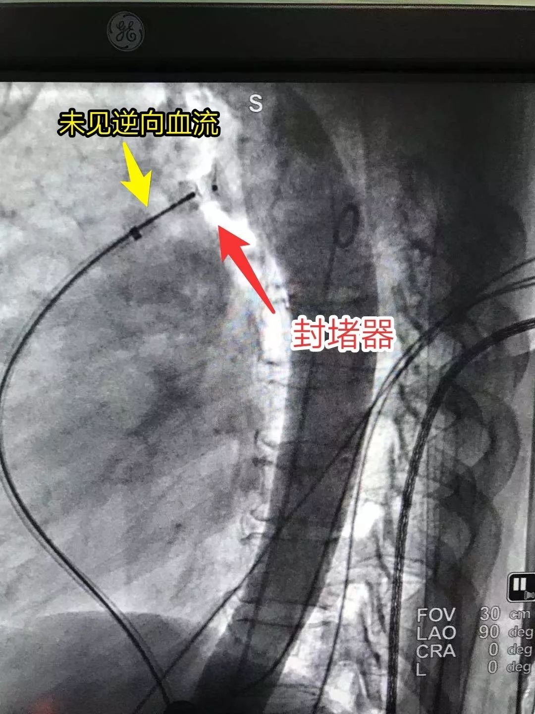 先锋快报心脏上有个洞医生用微创手术为她堵住